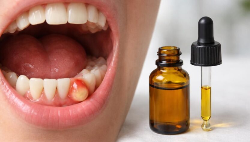 découvrez si le cbd peut aider à faire disparaître un abcès dentaire, ses effets potentiels et les précautions à prendre pour soulager la douleur naturellement.